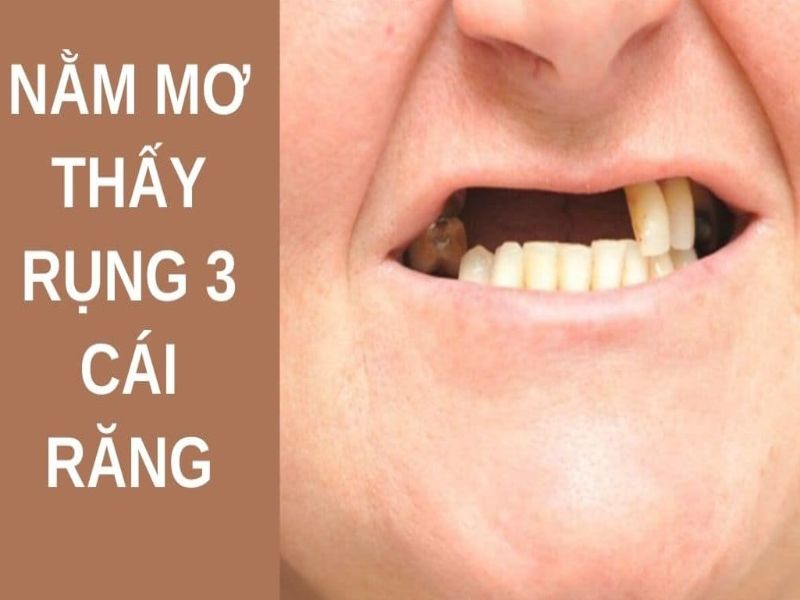 Mơ rụng 3 cái răng là điềm báo xấu hay tốt?